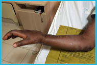 Wrist Deformity Correction